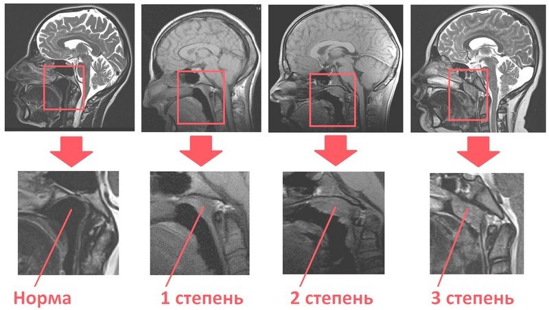 Лечение аденоидов без операции